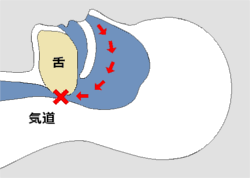 睡眠時無呼吸症候群
